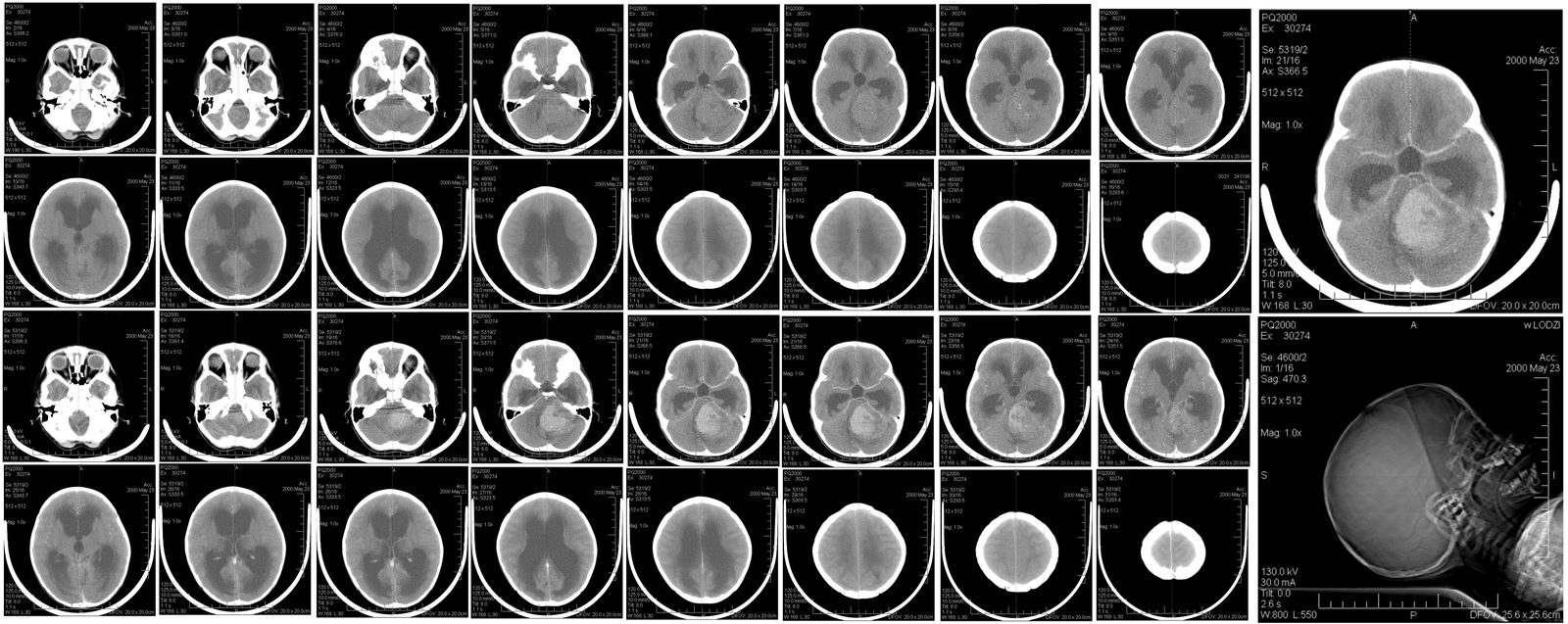 Non-contrast CT in a 6-year-old child showing a posterior-fossa mass with obstructive hydrocephalus
