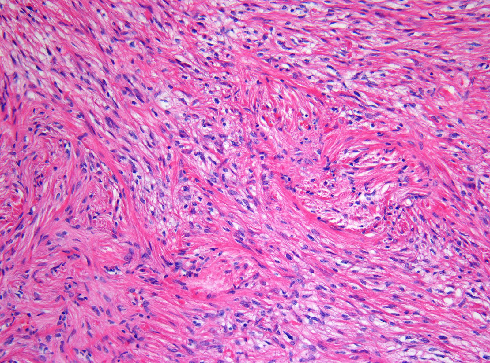 Histopathology of pilocytic astrocytoma, H&E stain at 200x magnification