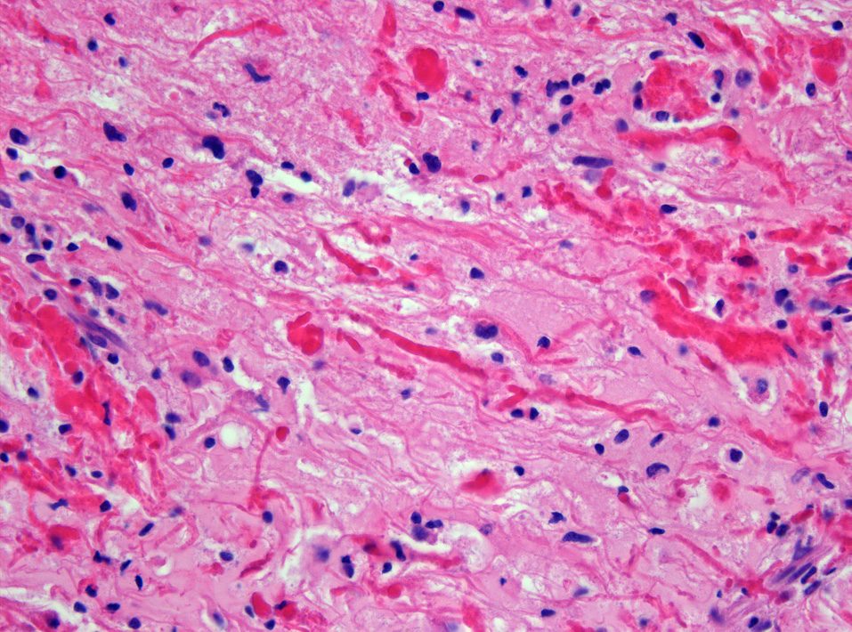 Rosenthal fibers in pilocytic astrocytoma, H&E stain at 400x magnification
