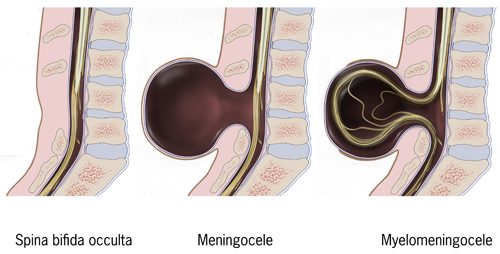 Diagram showing three types of spina bifida; spina bifida occulta, meningocele, and myelomeningocele